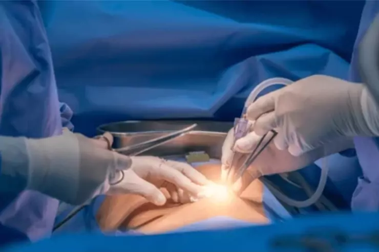 Hysteroscopy (Diagnostic & Operative)