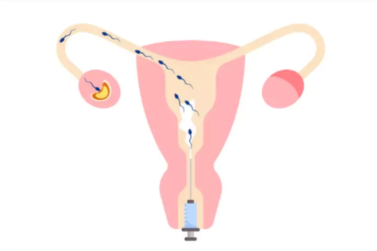 Intrauterine Insemination (IUI)