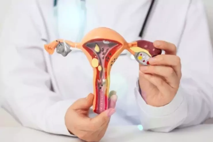 Ovarian Cysts and Tumors