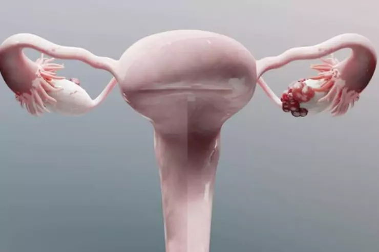Ovarian Cystectomy