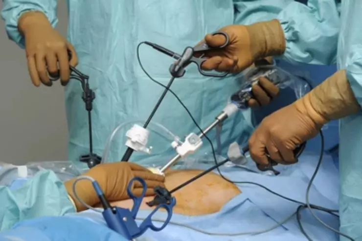 Total Laparoscopic Hysterectomy (TLH)