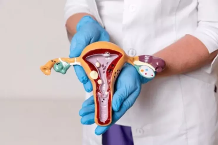 Uterine Fibroids and Tumors